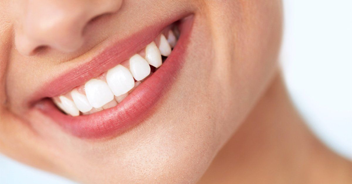 Professional Teeth Whitening  Florida