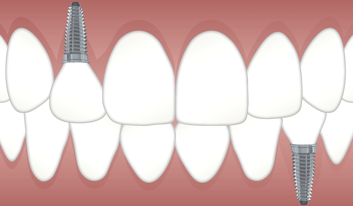 tooth implant problems