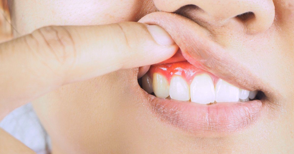 gum disease stages