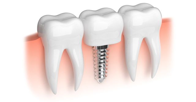Dental implants near me