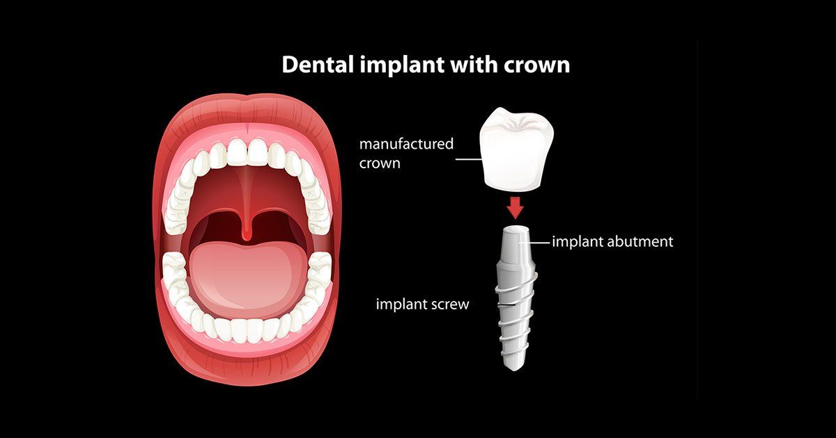 dental crowns, dentist in corning ny