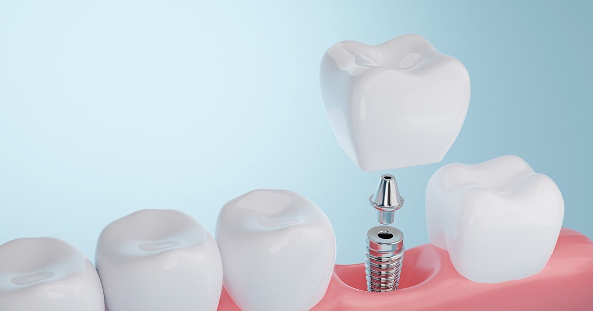 Dental Implants in Corning NY
