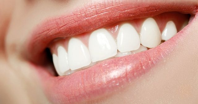 What Are Fastbraces for Teeth?