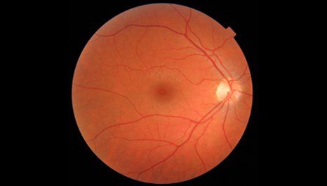 retinal treatments without insurance