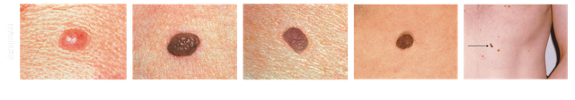 Benign mole comparison reference