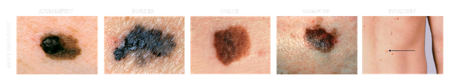 Malignant melanoma ABCDE warning-sign reference