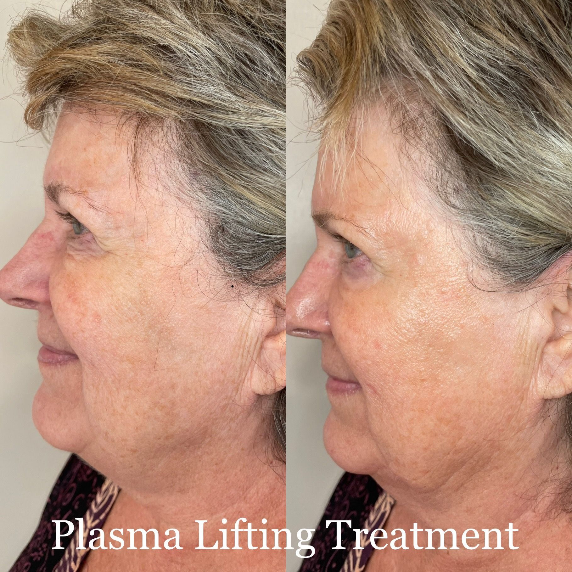 A woman 's face is shown before and after a plasma lifting treatment.