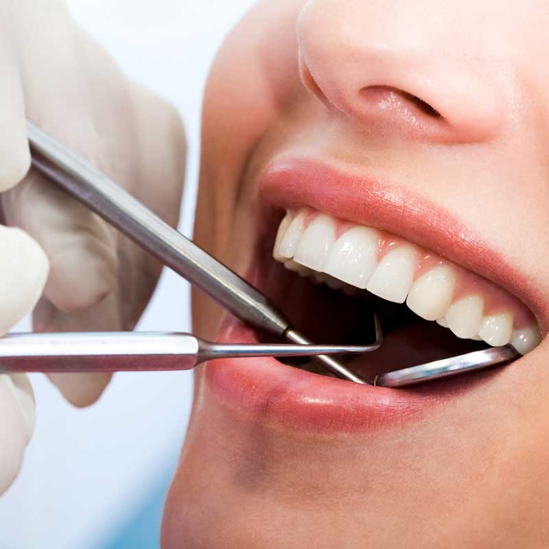 Tratamiento de Endodoncia