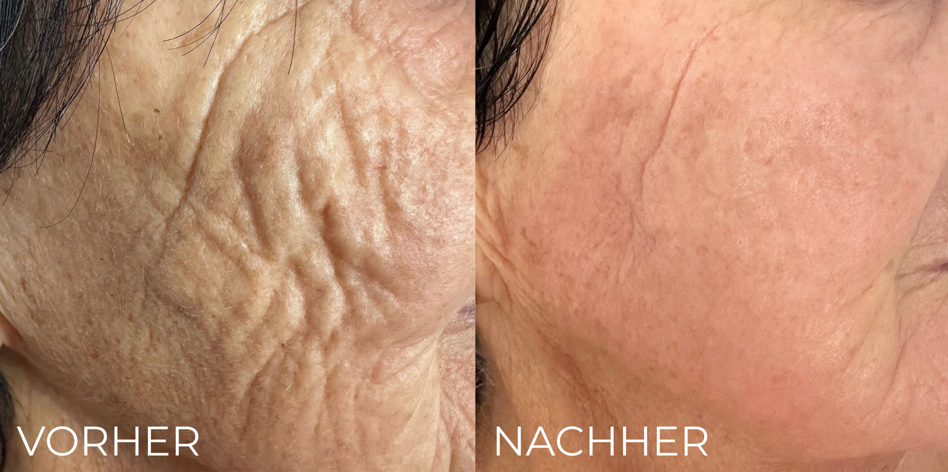 Ein direkter Vergleich der Hautstruktur zeigt tiefe Falten auf der linken Seite und ein glatteres Hautbild auf der rechten Seite.
