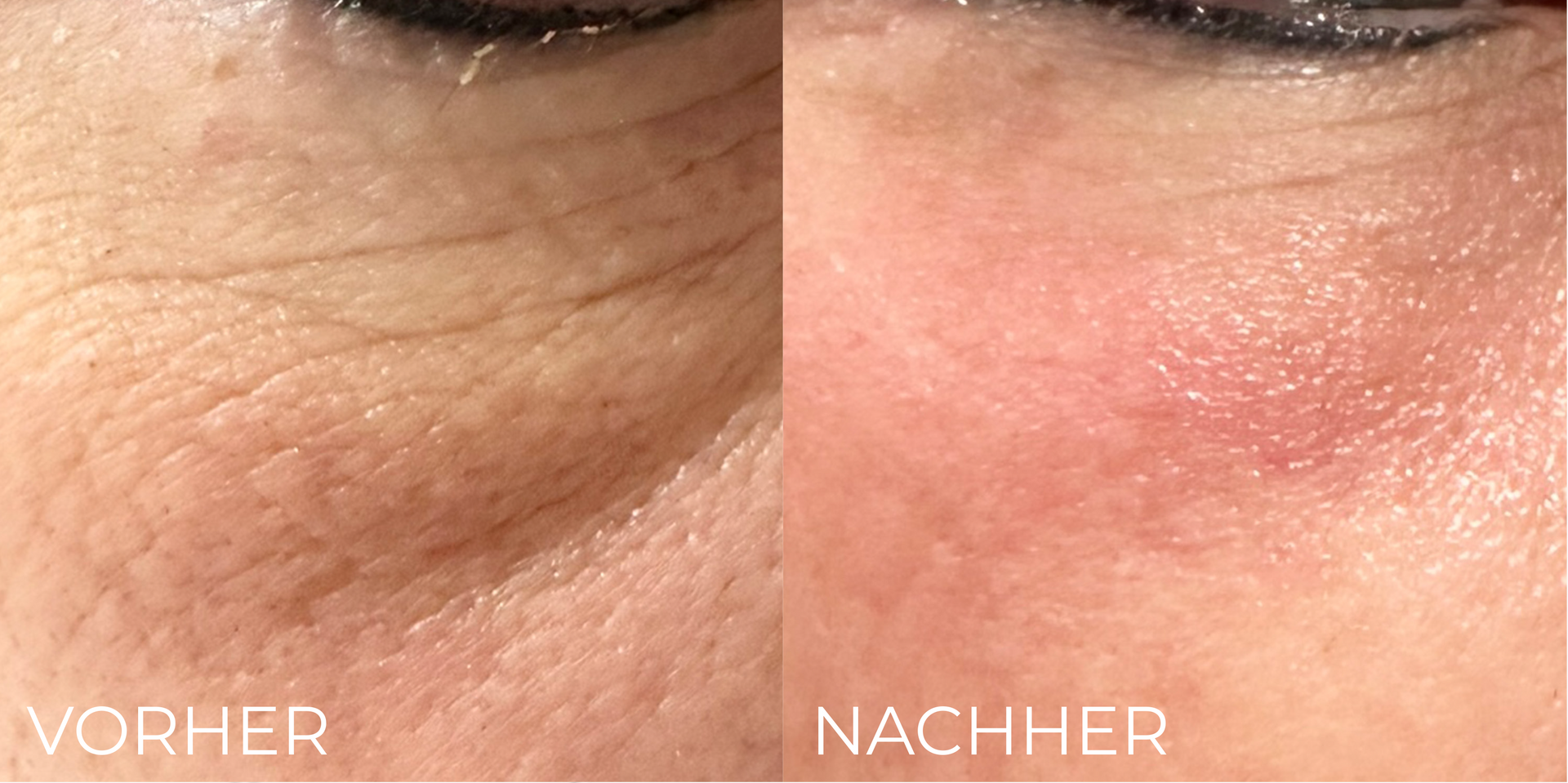 Direkter Vergleich der Haut vor und nach der Behandlung, der eine Reduzierung feiner Linien und eine Zunahme von Rötungen zeigt.