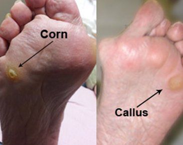Calluses and corn removal