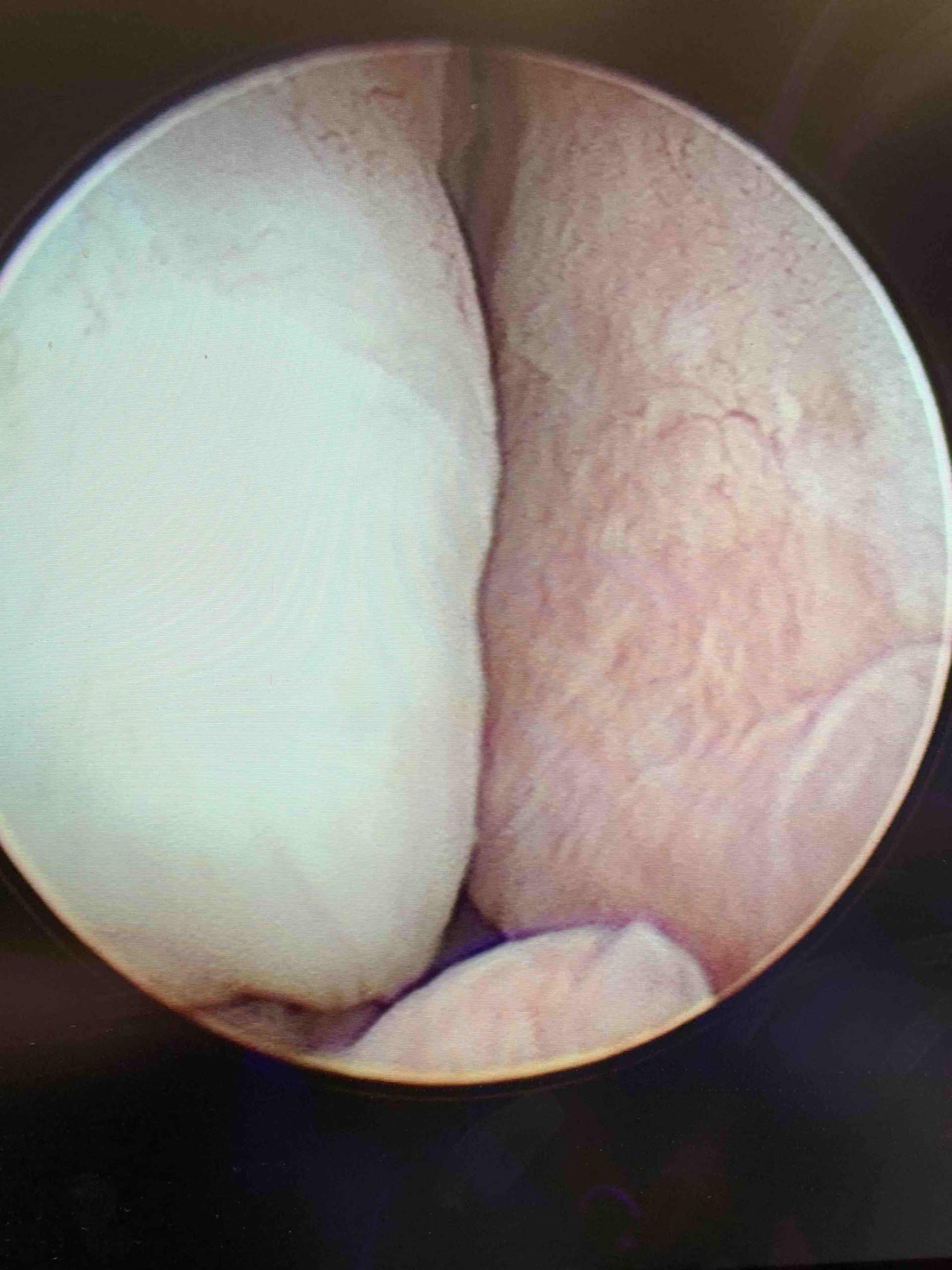 Prostate before Urolift
