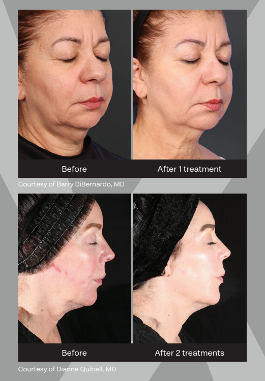 Before-and-after facial photos showing reduced swelling and sagging after treatment