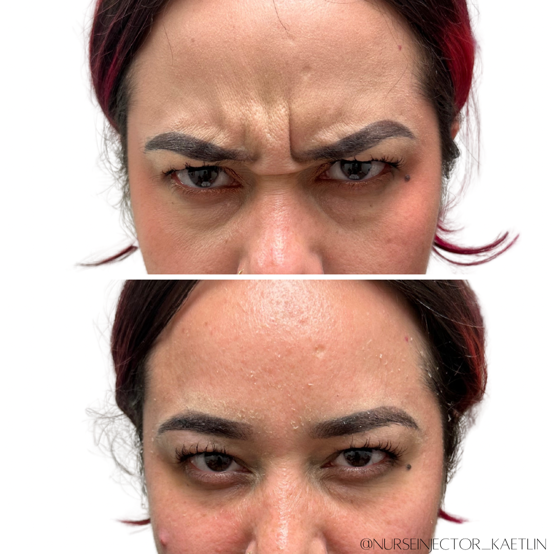 Top: Woman's furrowed brow. Bottom: Same woman, smooth brow. Before/after Botox example.