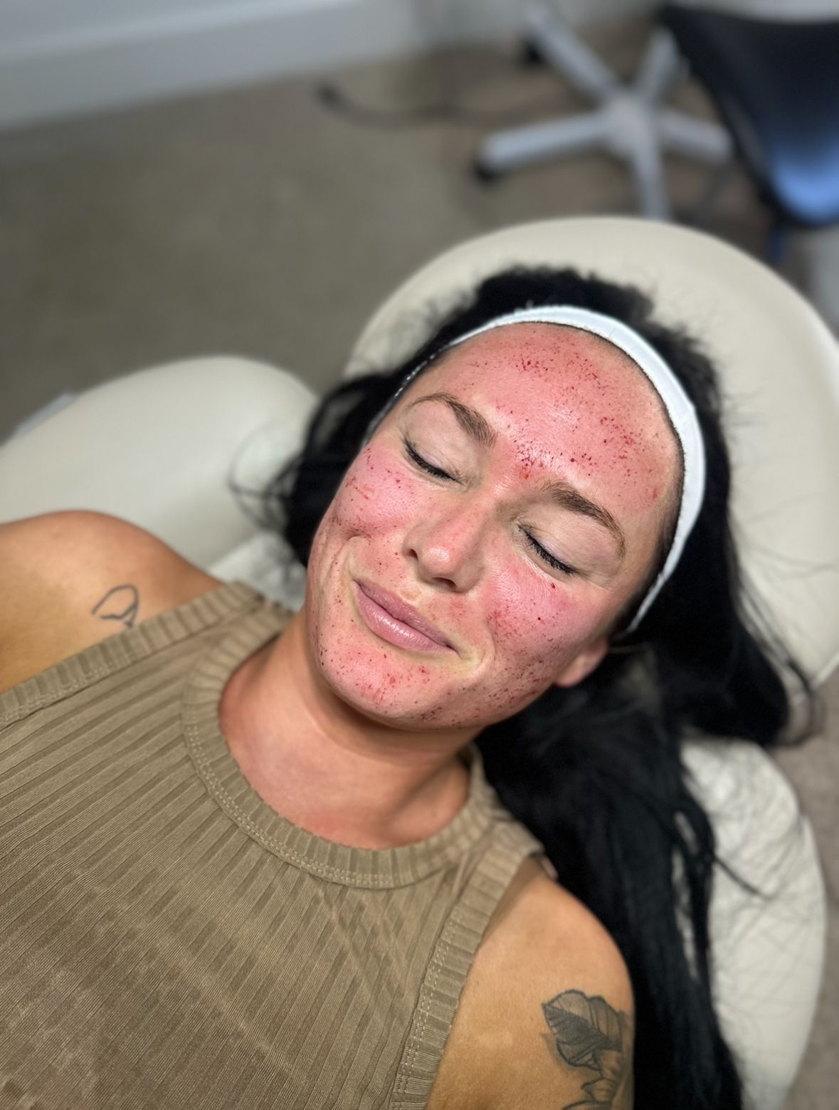 Woman with a headband, receiving a facial treatment, face marked with tiny red dots, lying on a treatment chair.