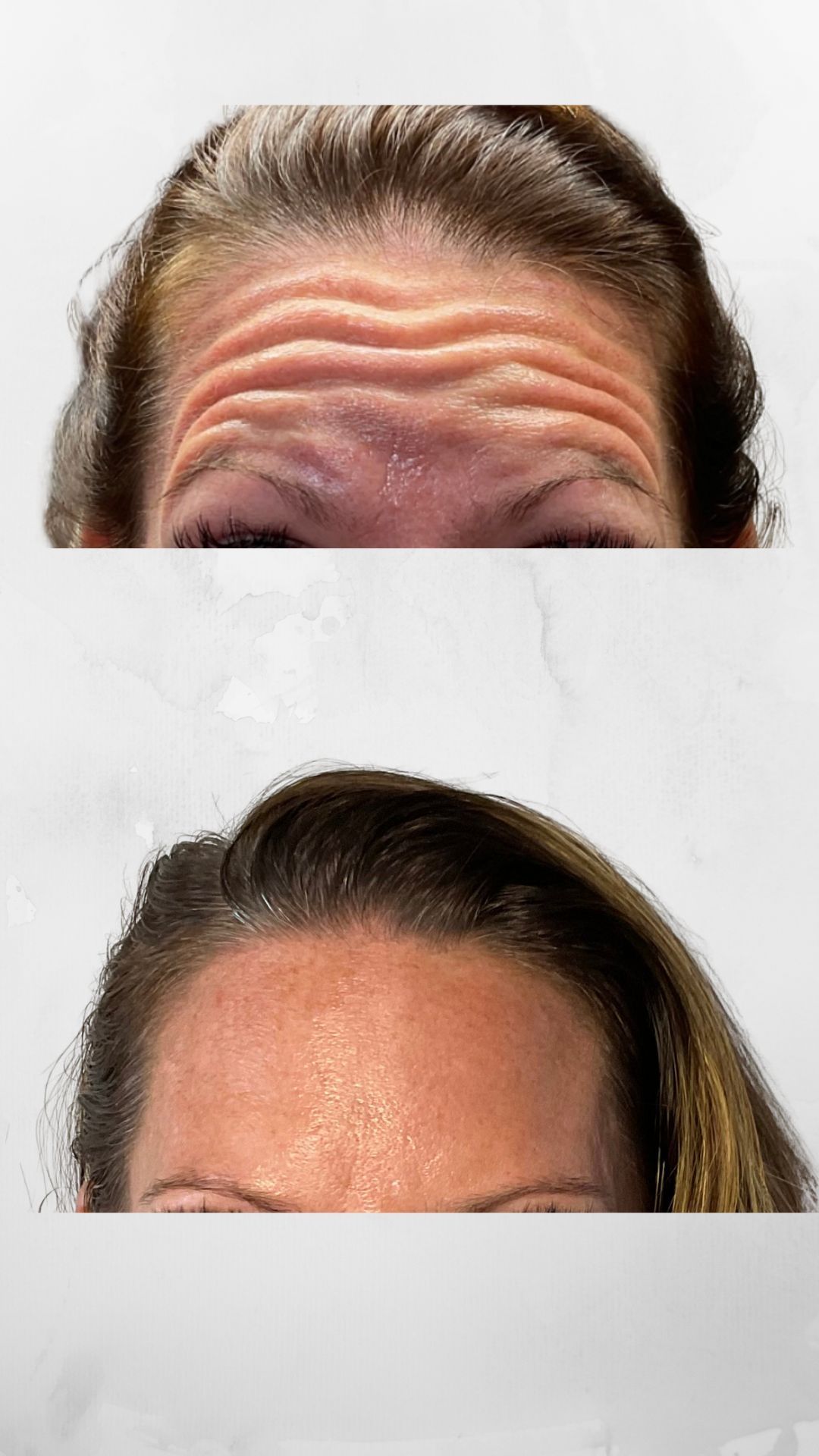Forehead with prominent wrinkles before and smooth after treatment.