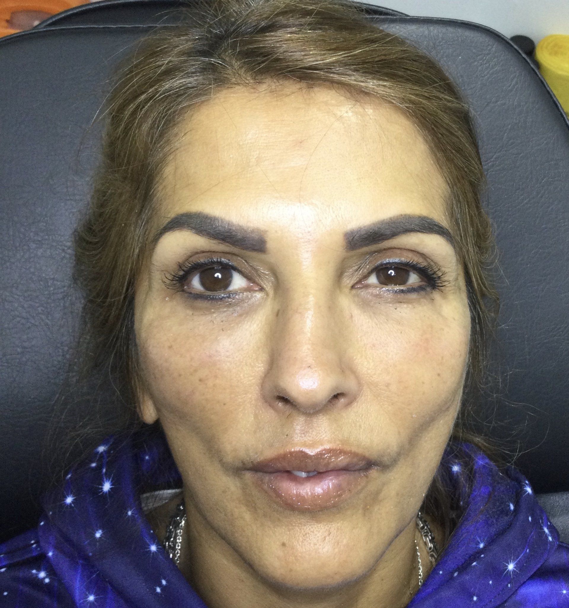after skin boosting injections, tear through fillers and anti wrinkle injections - After