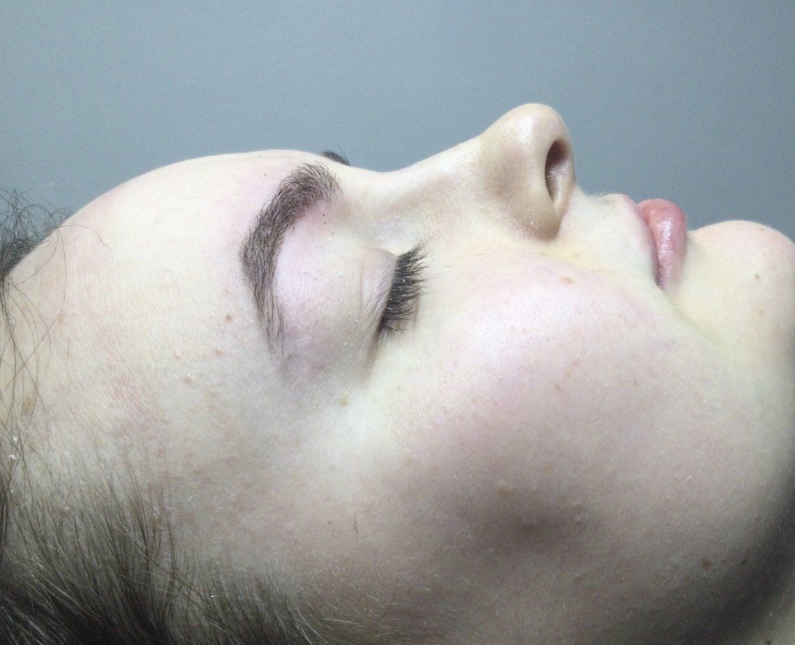 Rhinoplasty Nose Fillers 2 - Before