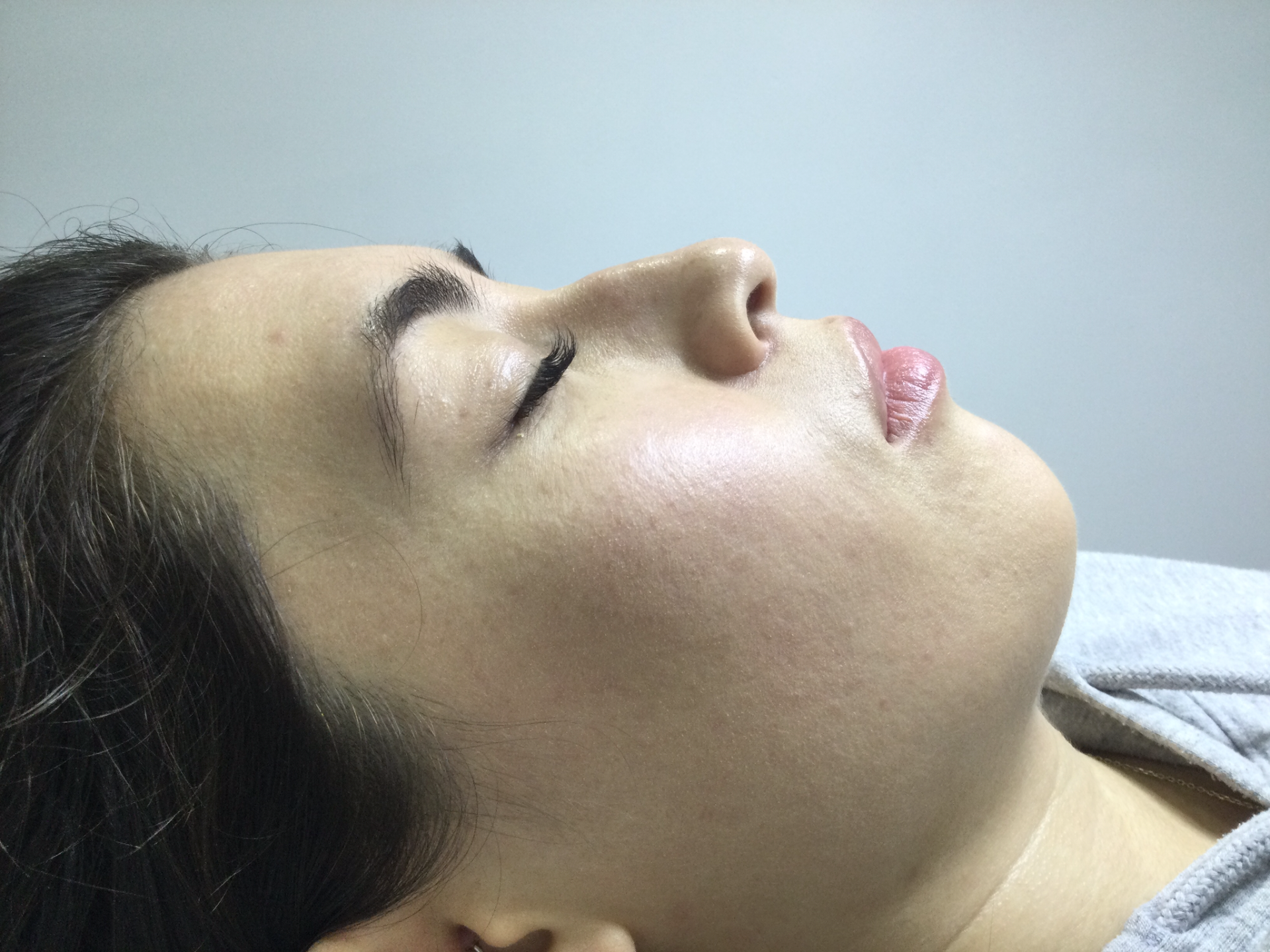 Rhinoplasty Nose Fillers 3 -Before