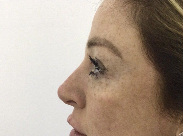 Rhinoplasty Nose Fillers - After