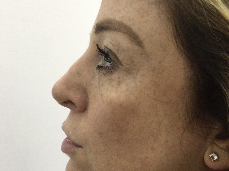 Rhinoplasty Nose Fillers - Before