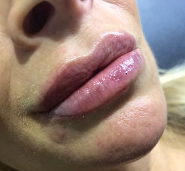 Lip Fillers After