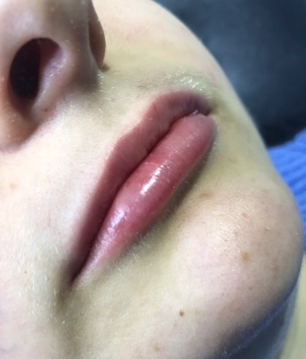 Lip Fillers - After
