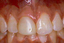 Teeth — Before Restoration in Springfield, IL