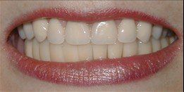 White Teeth — Clean and White Teeth in Springfield, IL