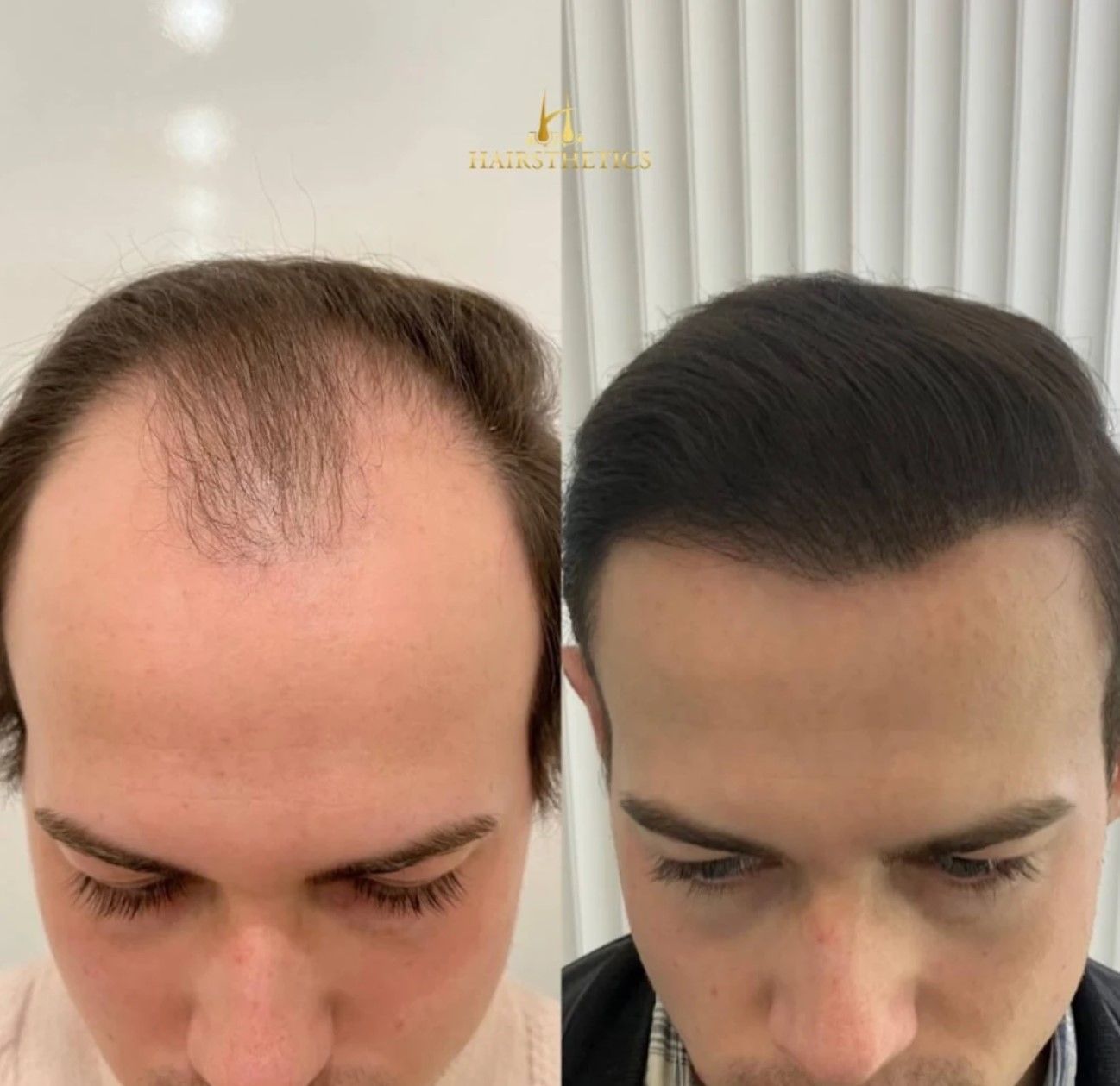A before and after photo of a man 's hair