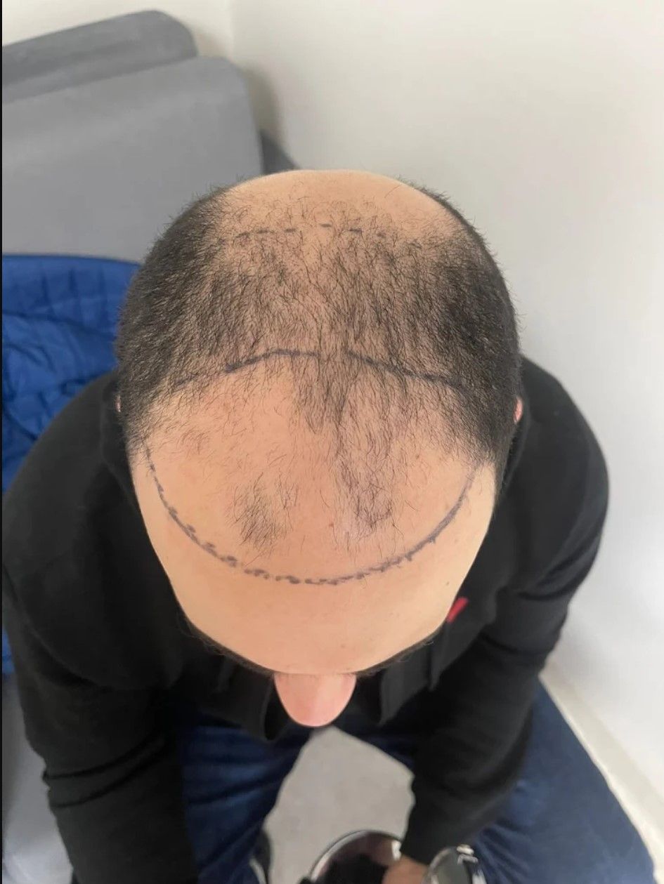 A man 's head with a line drawn on it.