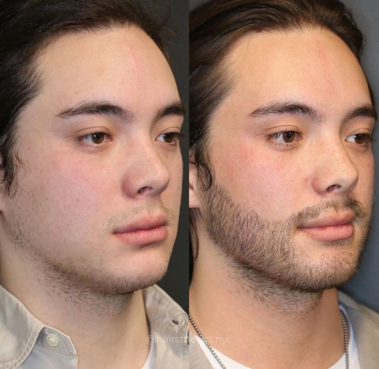 A before and after photo of a man with a beard.