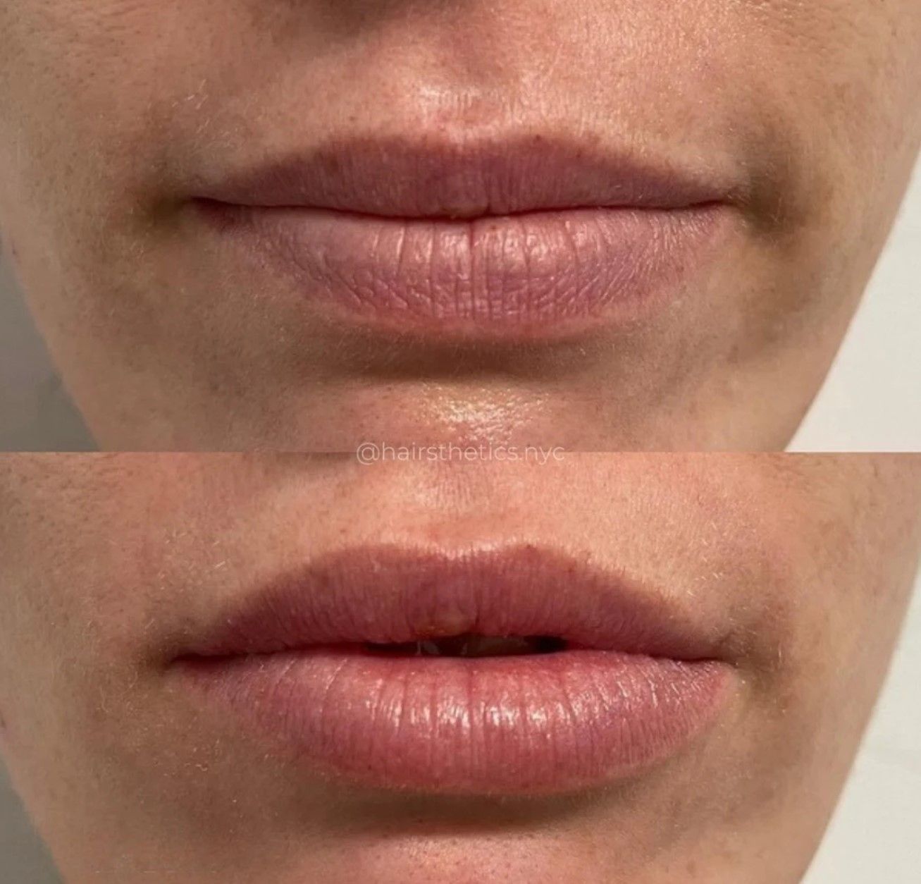 A before and after photo of a woman 's lips.