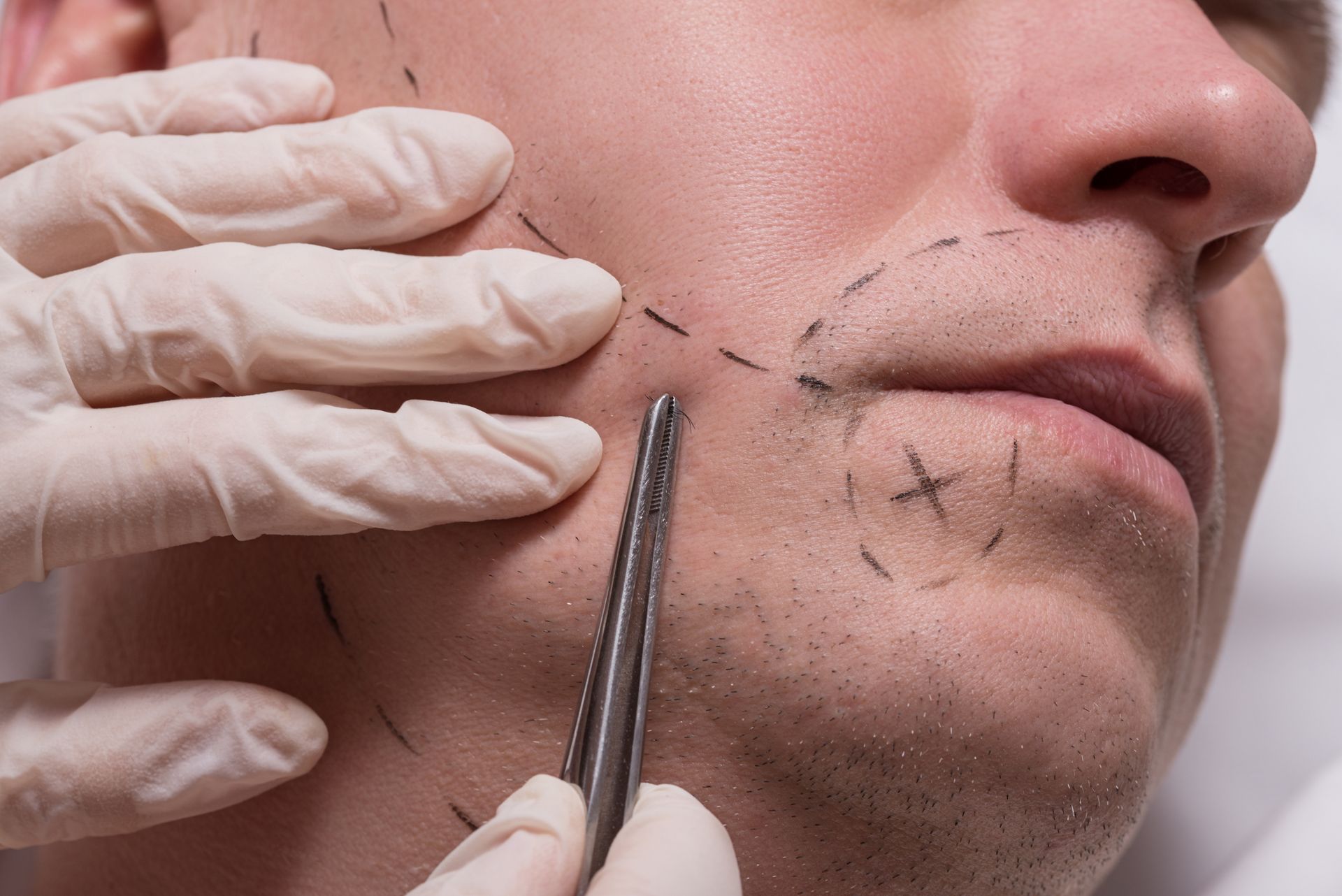 A man is getting a plastic surgery on his face.