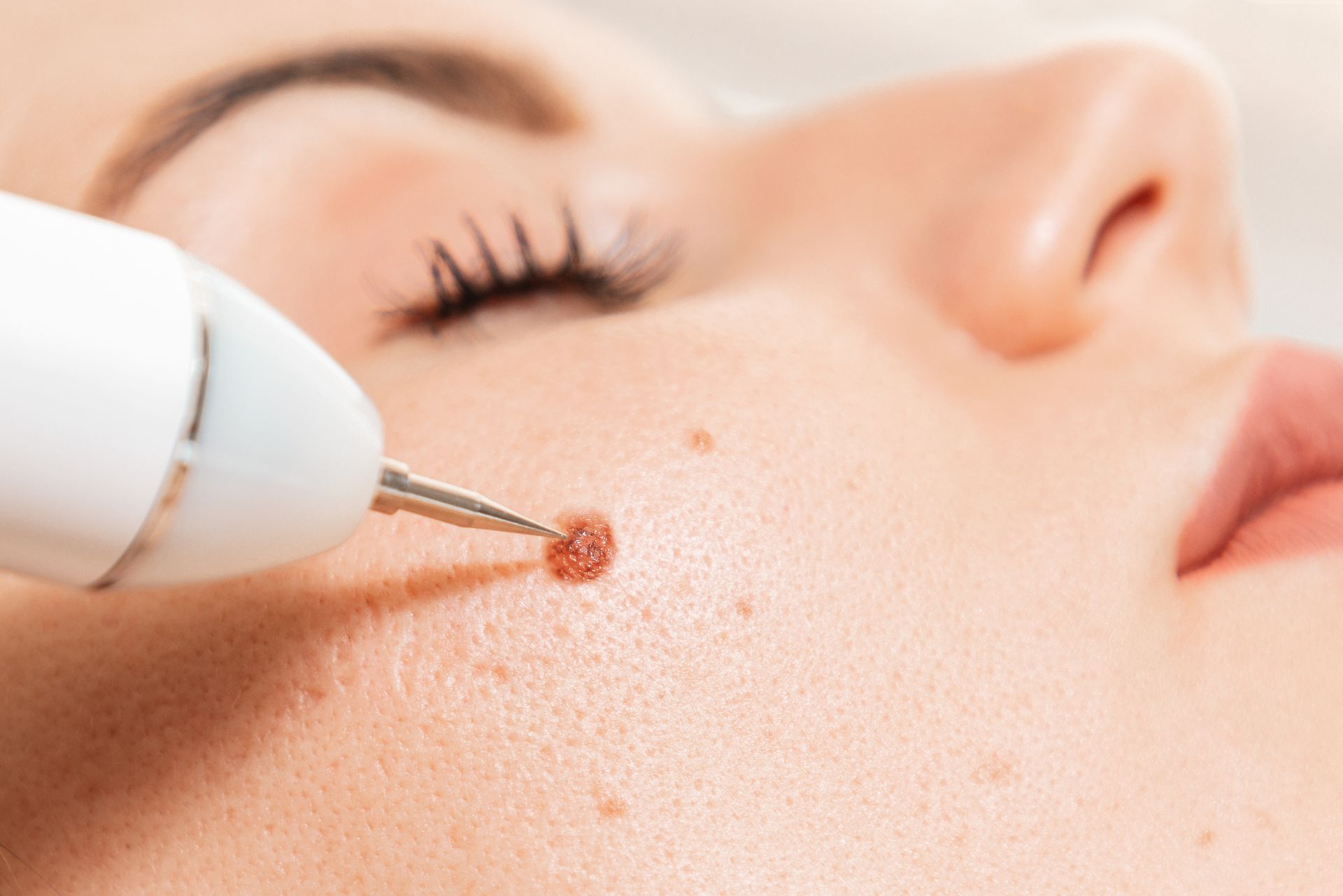A woman is getting a mole removed from her face.