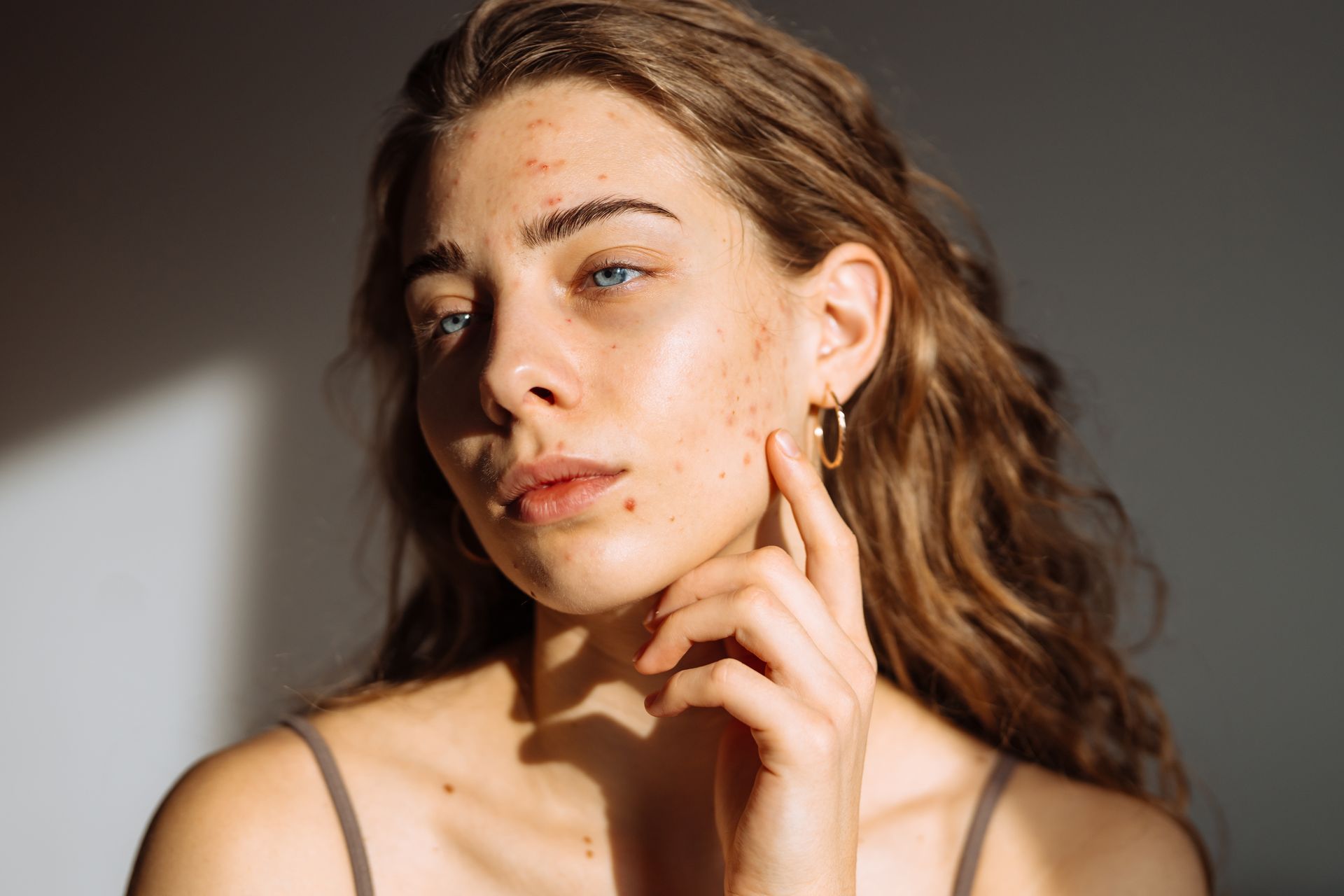 A woman with acne on her face is touching her face.