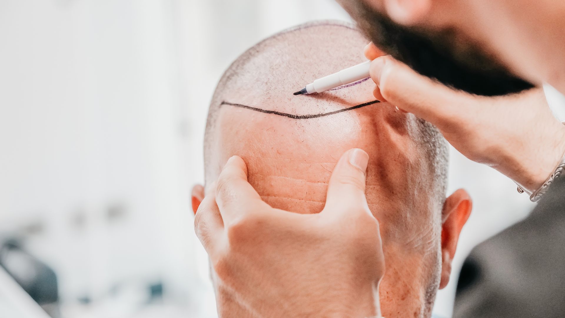 A man with a beard is getting a hair transplant from a surgeon.