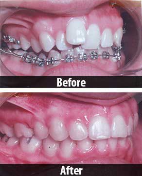 Dental — Before And After Braces In North Hills, CA
