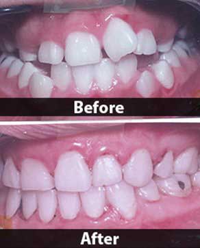 Family Dentist — Before And After Dental Care In North Hills, CA