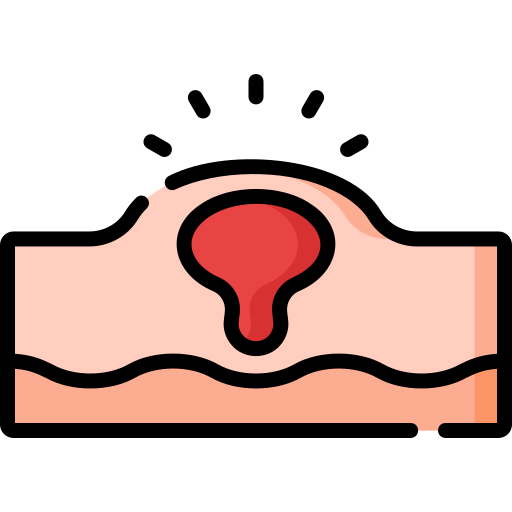 Akne på huden, röd bula med en framträdande glans.