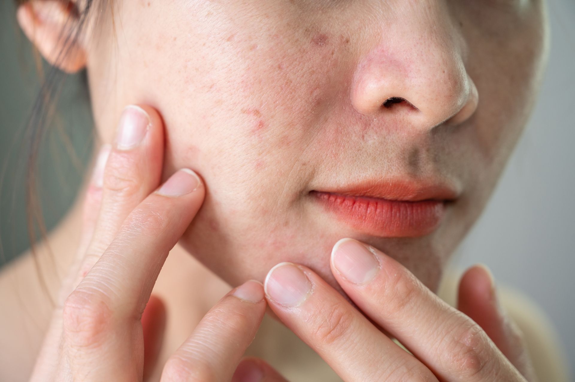 A woman with acne on her face is touching her face with her hands.