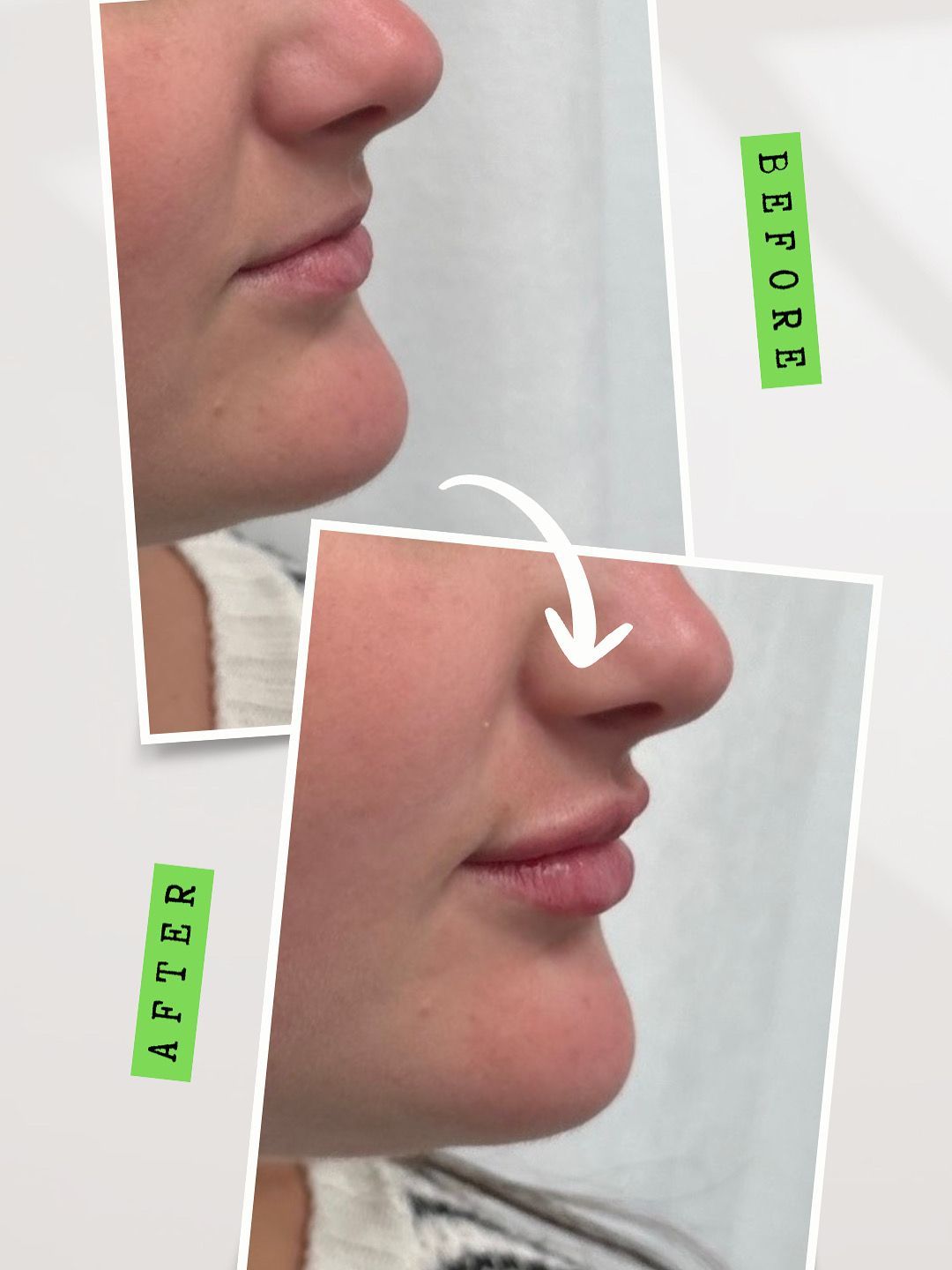 Before-and-after photo of a woman's profile. The 