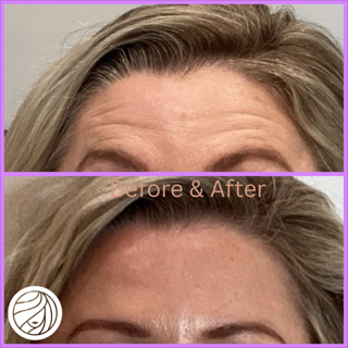 Forehead wrinkle reduction comparison; Before/After. Woman's face shows less forehead wrinkles after treatment.