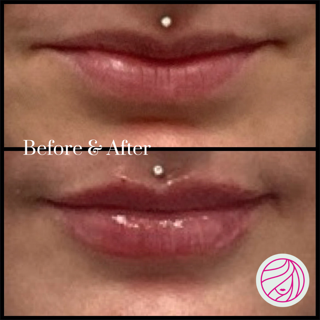 Before and after comparison of lip filler, showing fuller lips in the