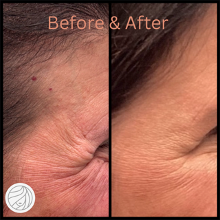 Before and after close-up of a person's face. Wrinkles are visible in the before, and smoothed out in the after.