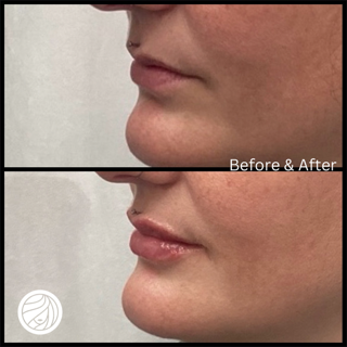 Side-by-side comparison of a person's face before and after lip filler. Lips appear fuller in the after photo.