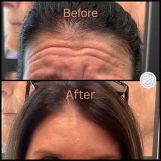 Before and after comparison of forehead wrinkles. The “After” photo shows smoother skin.