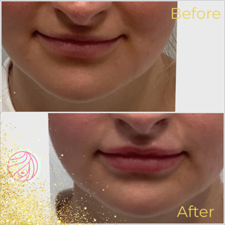 Before and after lip filler: Top, thinner lips; bottom, fuller lips; fair skin, indoors.