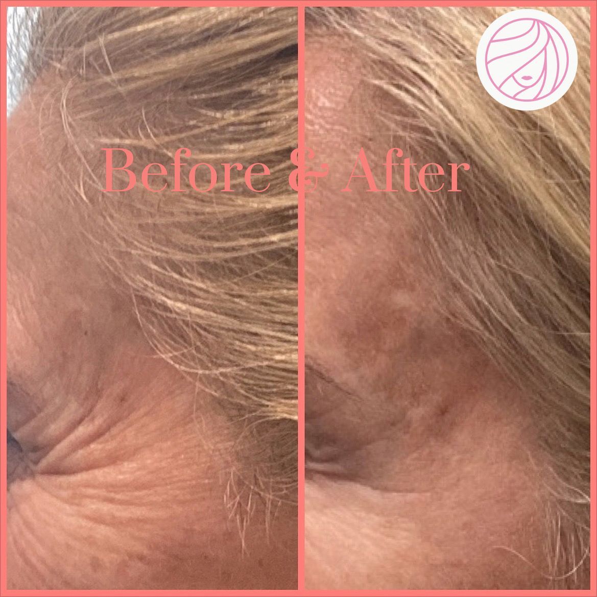 Side-by-side comparison of a woman's face; left shows wrinkles before, right shows smoother skin after treatment.