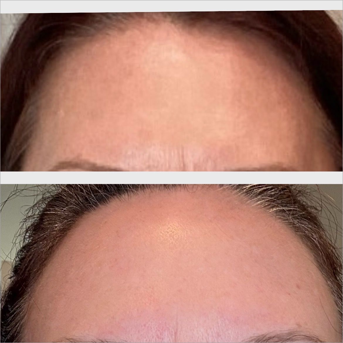 Before and after comparison of forehead with reduced wrinkles.